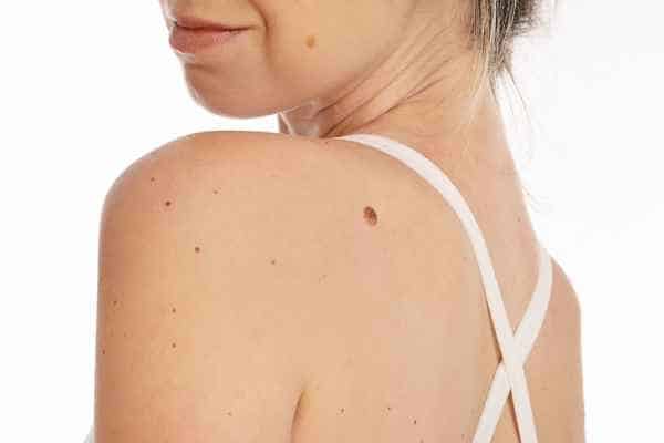 Dermatofibromas: What to Know About Treatment Options