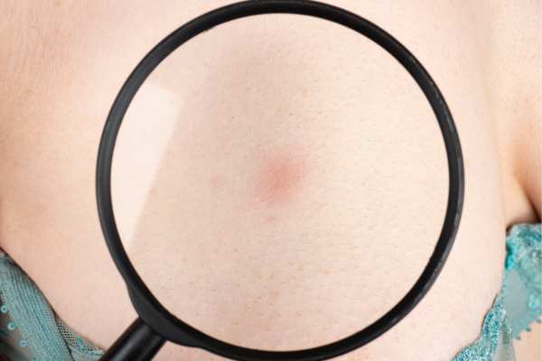 Dermatofibromas: What to Know About Treatment Options