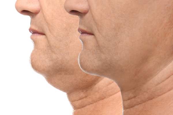 Book your Chin Reduction Treatment Livingston today!