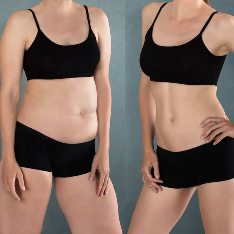 Does Fat Freezing at Home Work? DIY Devices vs Professional Cryolipolysis 2 before and after Cryolipolysis Livingston