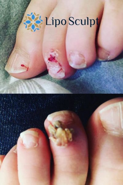 Wart removal customer results from Lipo Sculpt Livingston
