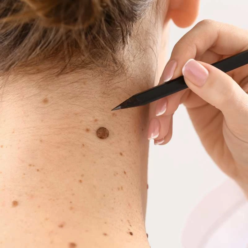 See our lesion removal prices Livingston - call today for a free quote