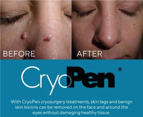 image of angiofibroma removal Livingston using Lipo Sculpt cryopen!